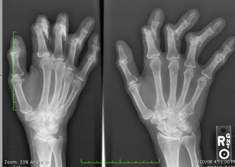 Osteoarthritis and zinc-Chiropractic News