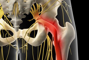 Causes of sciatica pain