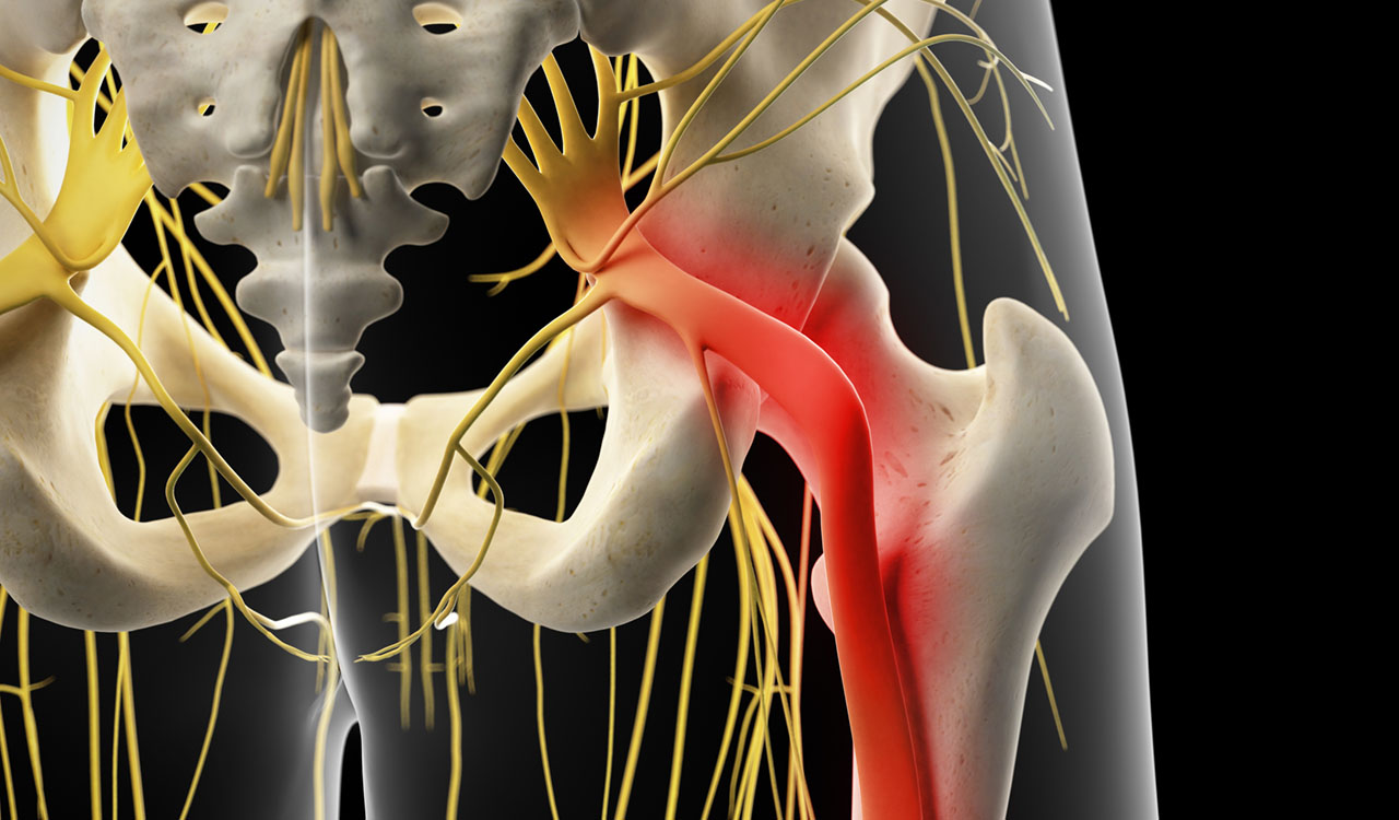 9 Risk Factors for Developing Sciatica